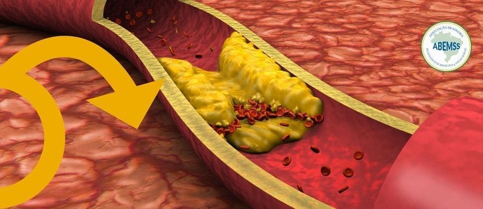 O colesterol elevado pode causar Disfunção Erétil