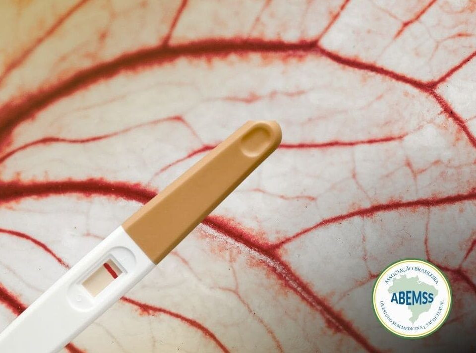 Varicocele e fertilidade o que realmente muda