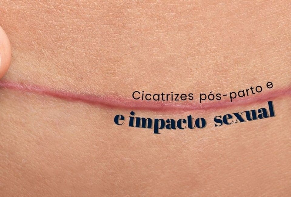 Cicatrizes pós-parto e impacto sexual