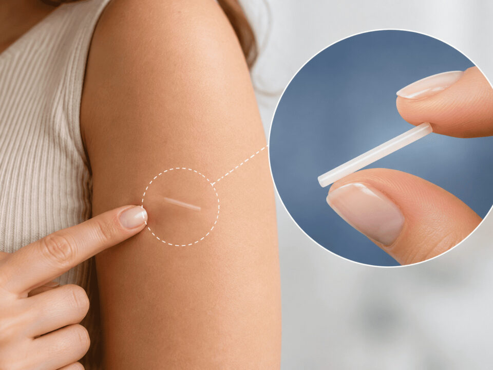 Implantes hormonais